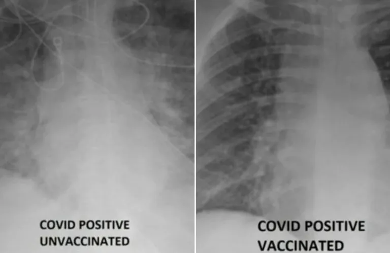 pluća koronavirus