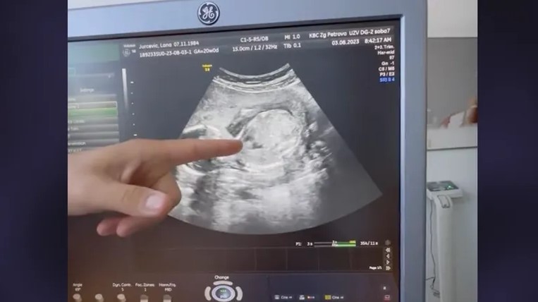 Lana Jurčević po prvi put podijelila snimku ultrazvuka